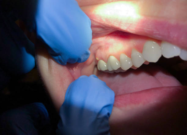 Best Emergency Gum Treatment in Mustang Ridge, TX