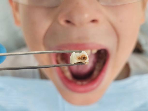 Best Emergency Tooth Extraction in Mustang Ridge, TX