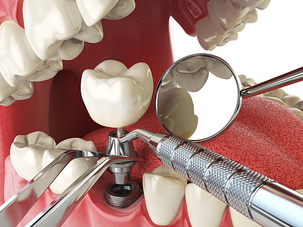 Best Emergency Treatment for Dental Infections or Abscesses in Mustang Ridge, TX